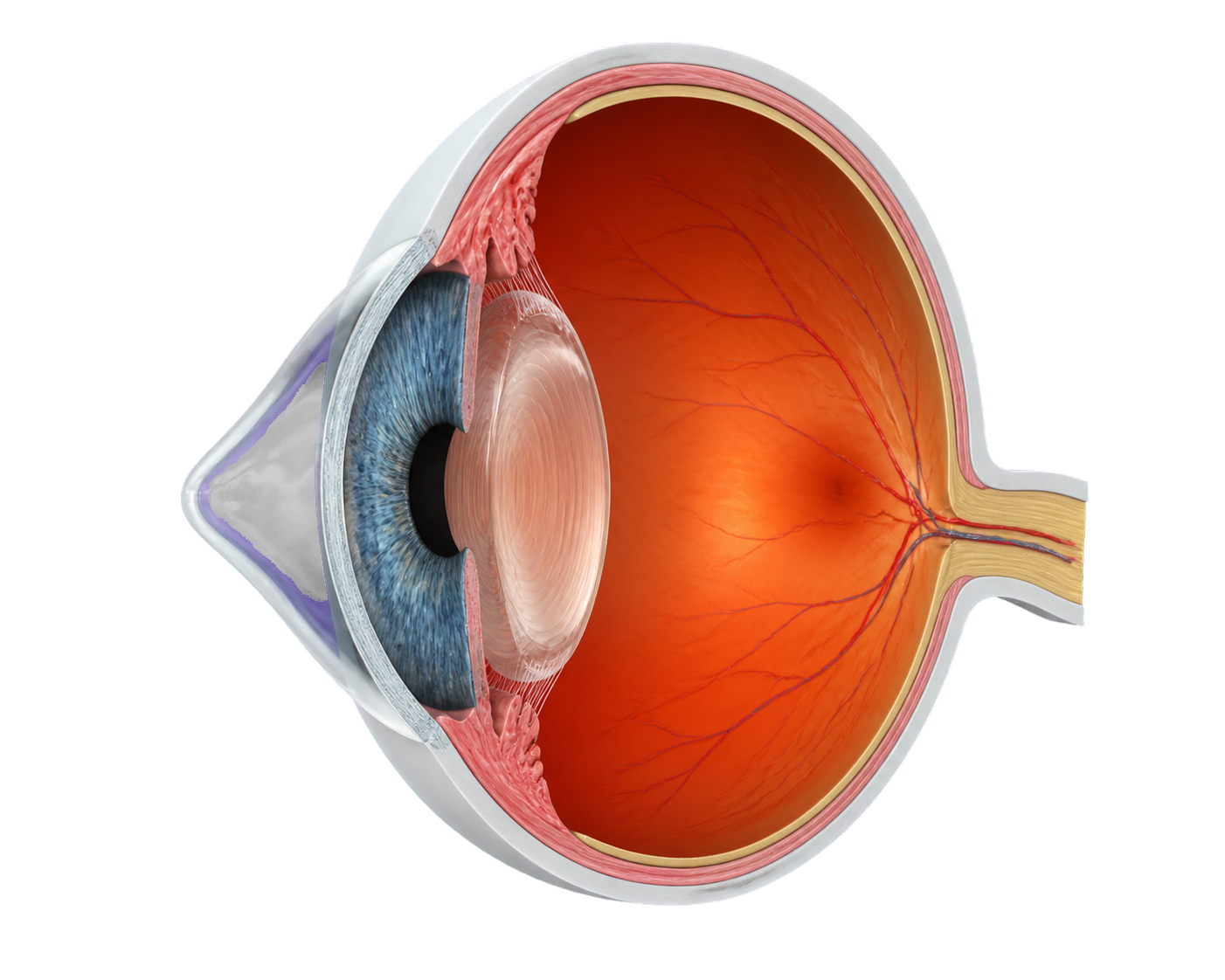 Sezione anatomica dell’occhio con cornea assottigliata e conica nel cheratocono