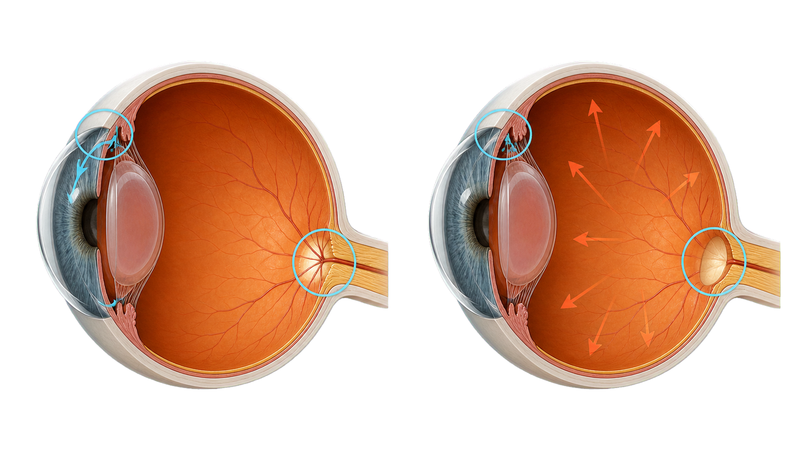 Confronto anatomico tra occhio sano e occhio con glaucoma, con deflusso ridotto e danno del nervo ottico