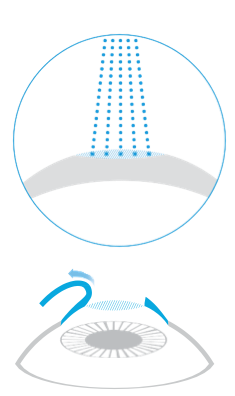 Schema della tecnica LASIK con creazione e sollevamento del flap corneale