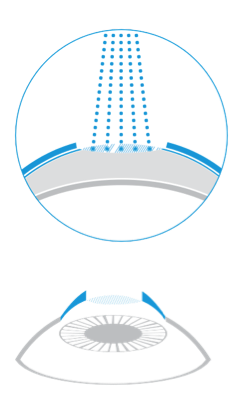 Schema della tecnica PRK con rimozione dell’epitelio e rimodellamento laser della superficie corneale