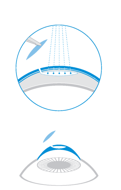 Schema della tecnica SMILE con creazione del lenticolo ed estrazione da microincisione