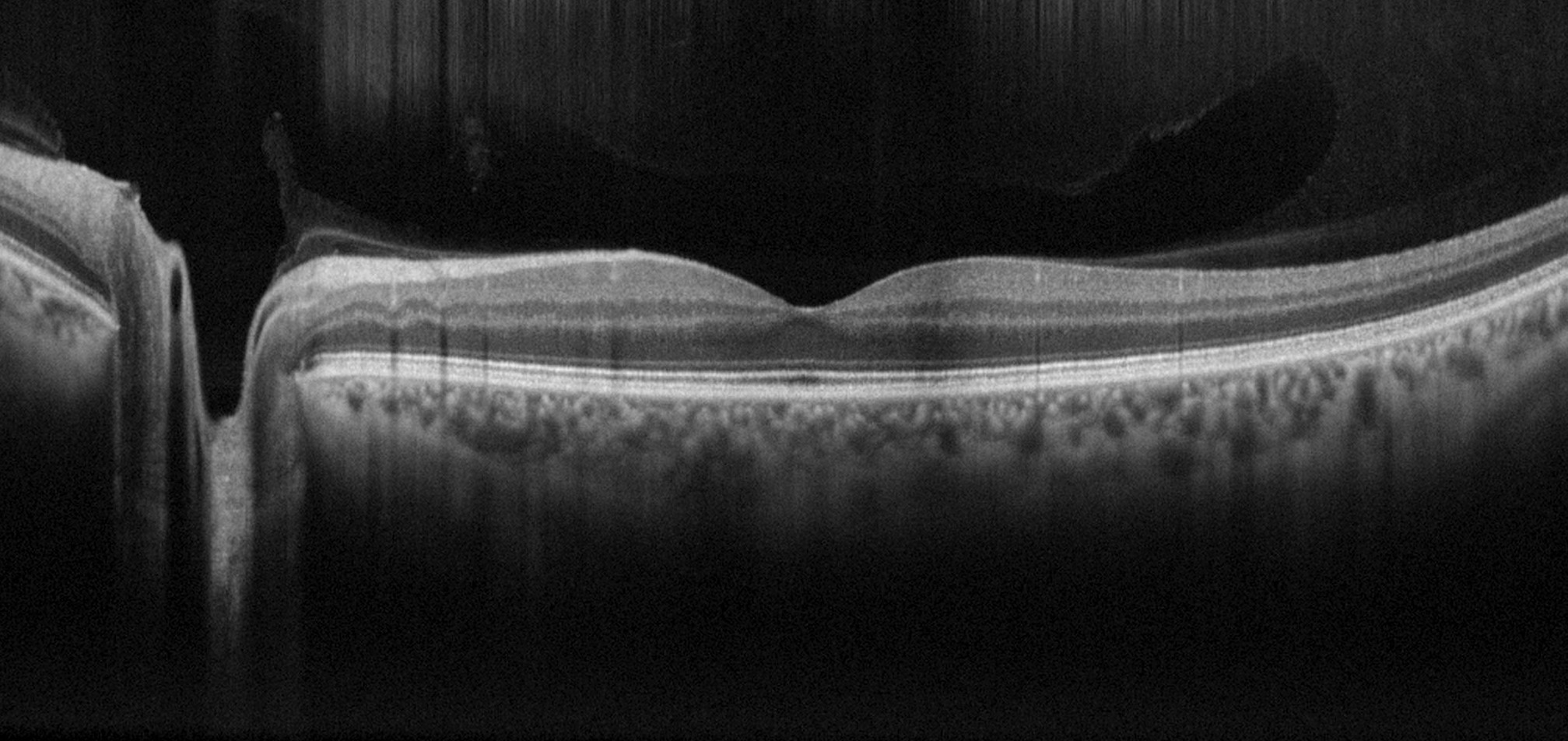 Scansione OCT degli strati della retina e della macula